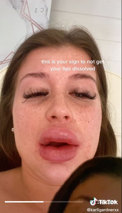 Los labios se comenzaron a hinchar poco a poco después de aplicar el relleno