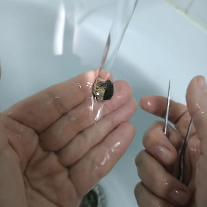 Los médicos procedieron a remover el cuerpo calcificado, lavaron la moneda y se la dieron al paciente como recuerdo (Departamento de Salud de Moscú)