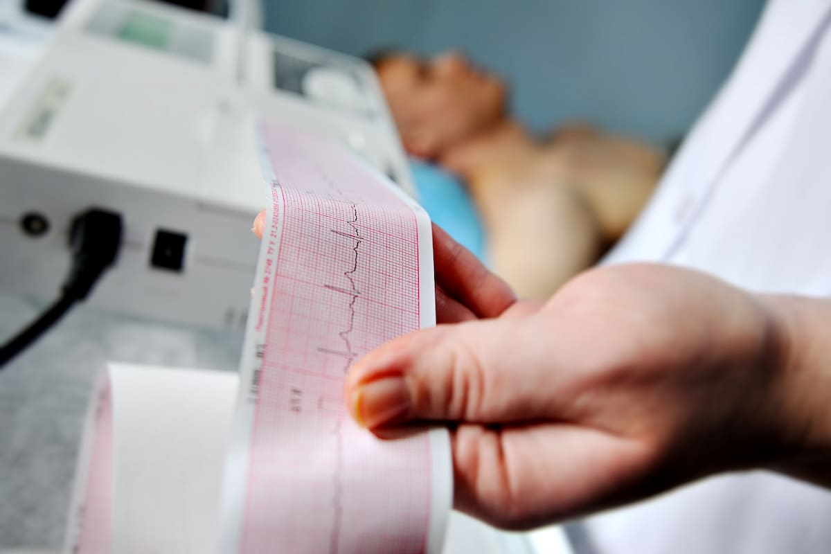 Los médicos suelen diagnosticar la fibrilación auricular mediante un electrocardiograma