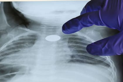 Los niños tienden a inhalar o ingerir todo tipo de objetos, con serios riesgos para la salud, incluyendo la muerte