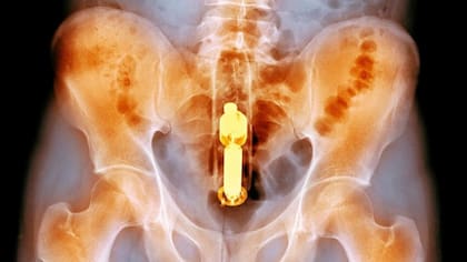 Los objetos extraños en el ano o el recto pueden causar un ensanchamiento significativo del tracto digestivo con el riesgo de una perforación o ruptura