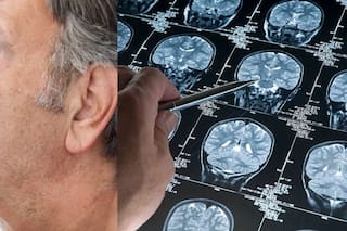 Alzheimer: crean nanopartículas que favorecen la regeneración neuronal y mejoran la memoria