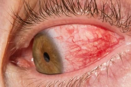 Los ojos rojos podrían ser un síntoma clave