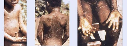Los primeros casos de viruela del mono o Monkeypox se detectaron en 1985, según los Centros para el Control y la Prevención de Enfermedades