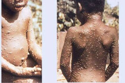 Los primeros casos se detectaron en 1985, según los Centros para el Control y la Prevención de Enfermedade