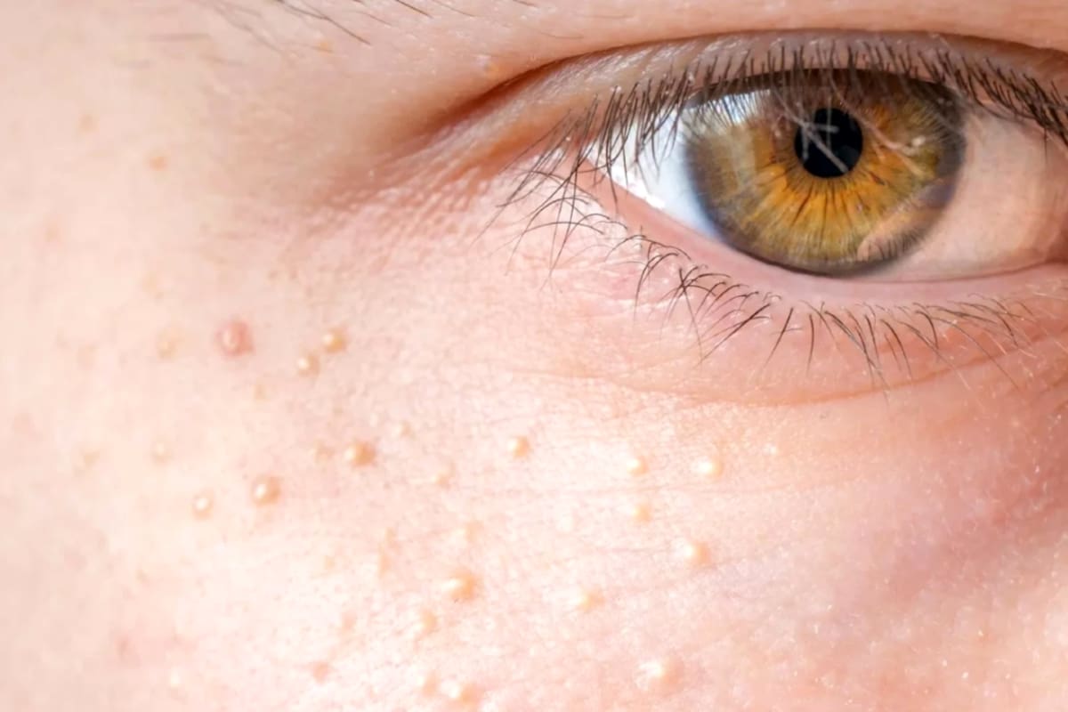 Los quistes de millium son pequeñas protuberancias blancas o amarillentas que aparecen en la piel, especialmente en el rostro