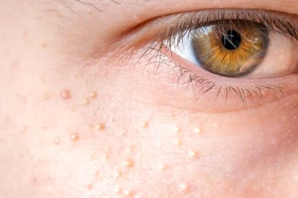 Los quistes de millium son pequeñas protuberancias blancas o amarillentas que aparecen en la piel, especialmente en el rostro