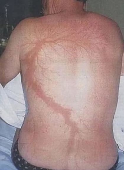 Los rayos le quemaron el pelo, las cejas y distintas partes del cuerpo; su caso fue reconocido por Guinness