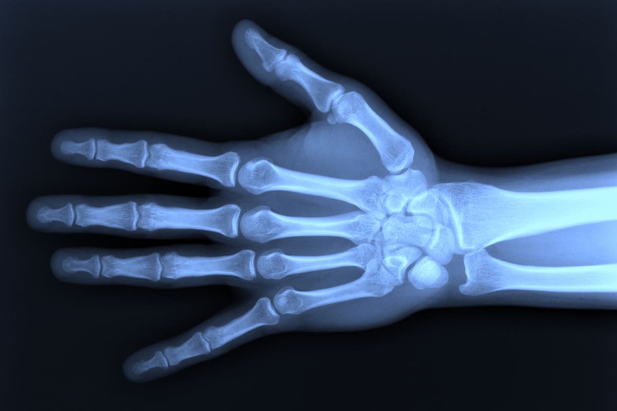 Los rayos X son el método más común para identificar fracturas, pero implican irradiar al paciente y requieren equipamiento e insumos que no siempre están disponibles cuando se los necesita, sobre todo fuera de las grandes ciudades