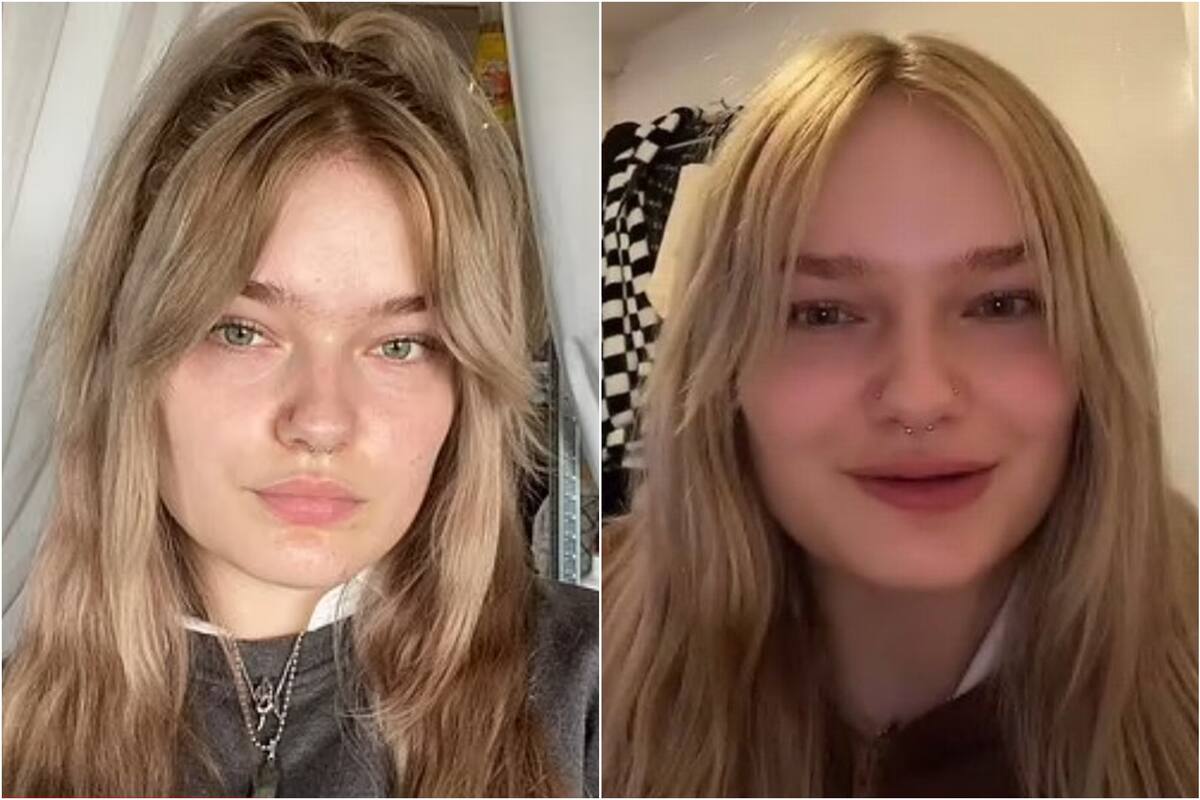 Los resultados de la aplicación de botox de Nikita Kimberly, de 21 años (Crédito: TikTok)