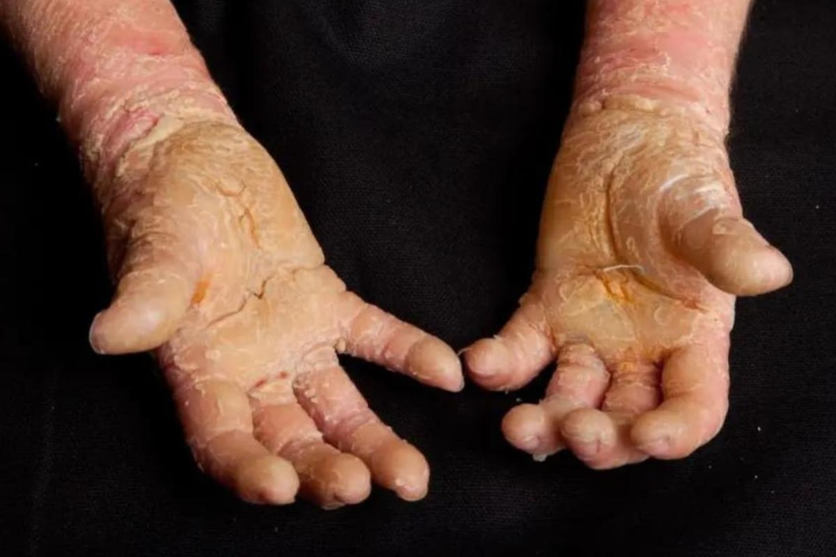 Los síntomas de esta enfermedad se suelen manifestar desde que la persona es un bebé (Foto: allergykb.org)