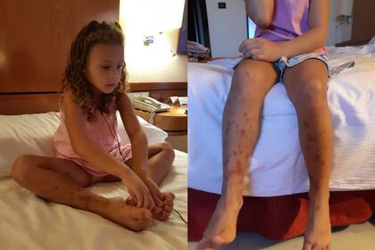Los síntomas de la Púrpura permenacen durante al menos un mes y deben ser tratados con medicamentos.