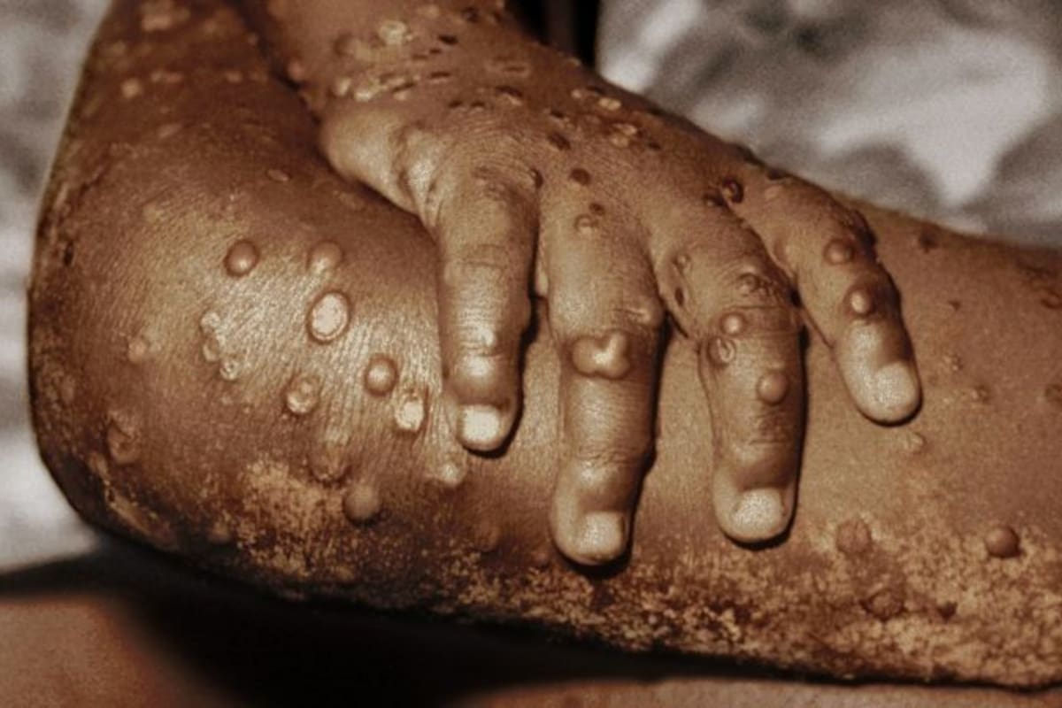 Los síntomas de la viruela del mono incluyen sarpullido, fiebre, dolor de cabeza, dolores musculares, dolor de espalda, ganglios linfáticos inflamados, escalofríos y agotamiento