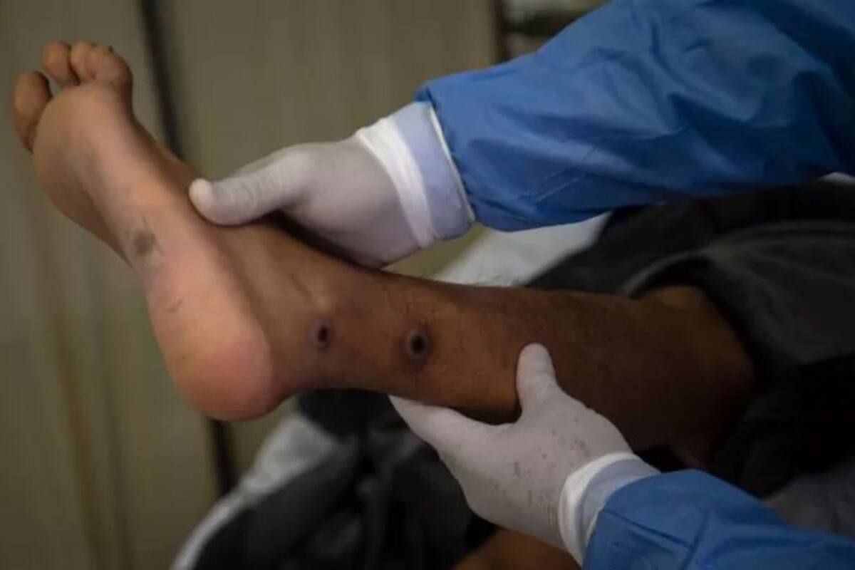 Los síntomas más comunes de la viruela del mono son fiebre (más de 38,5°C), aparición de pústulas en la piel, dolor corporal, cefalea o dolor de espalda, cansancio generalizado, inflamación de ganglios o del revestimiento interno del recto