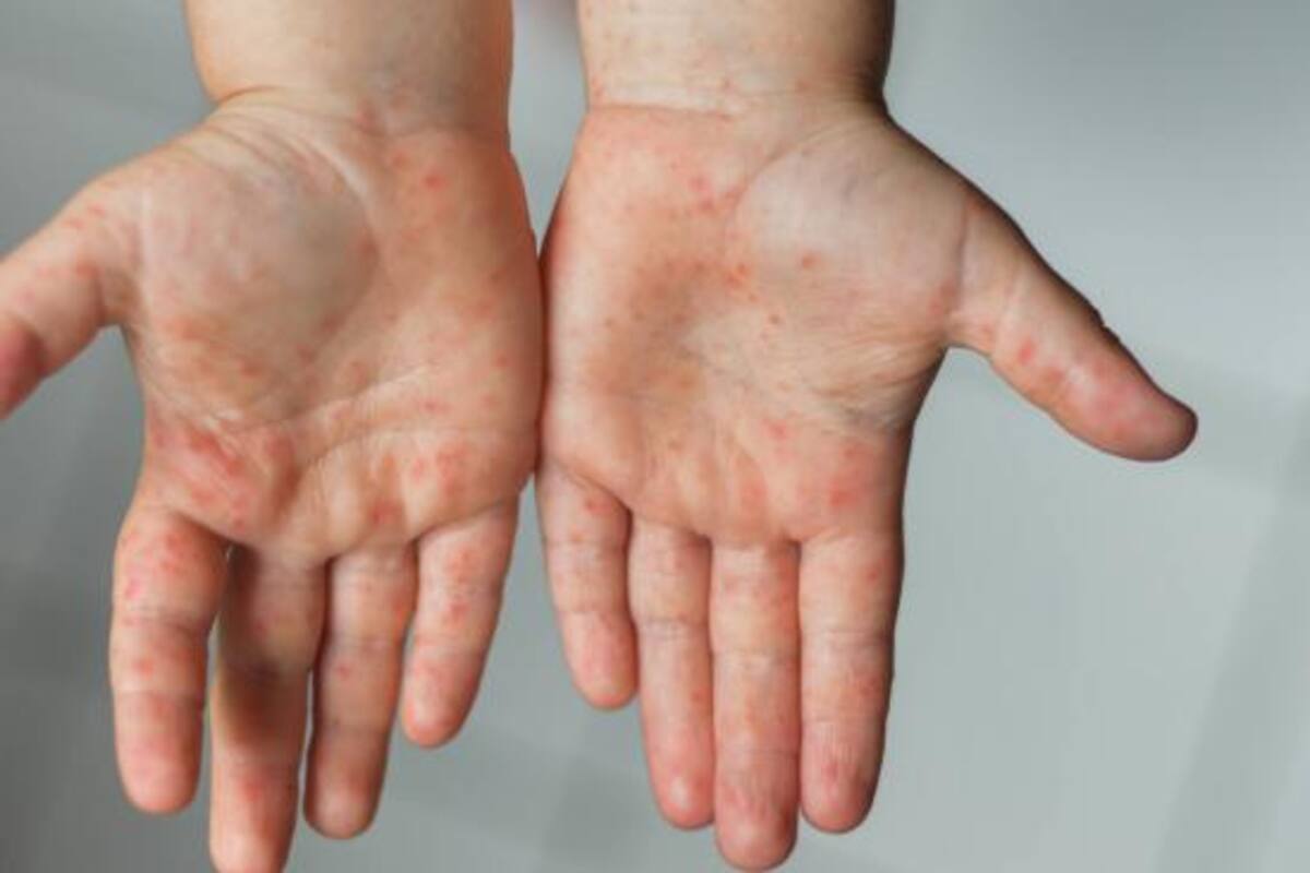 Los síntomas más frecuentes que presentaron fueron exantemas vesiculares, fiebre y dolor muscular