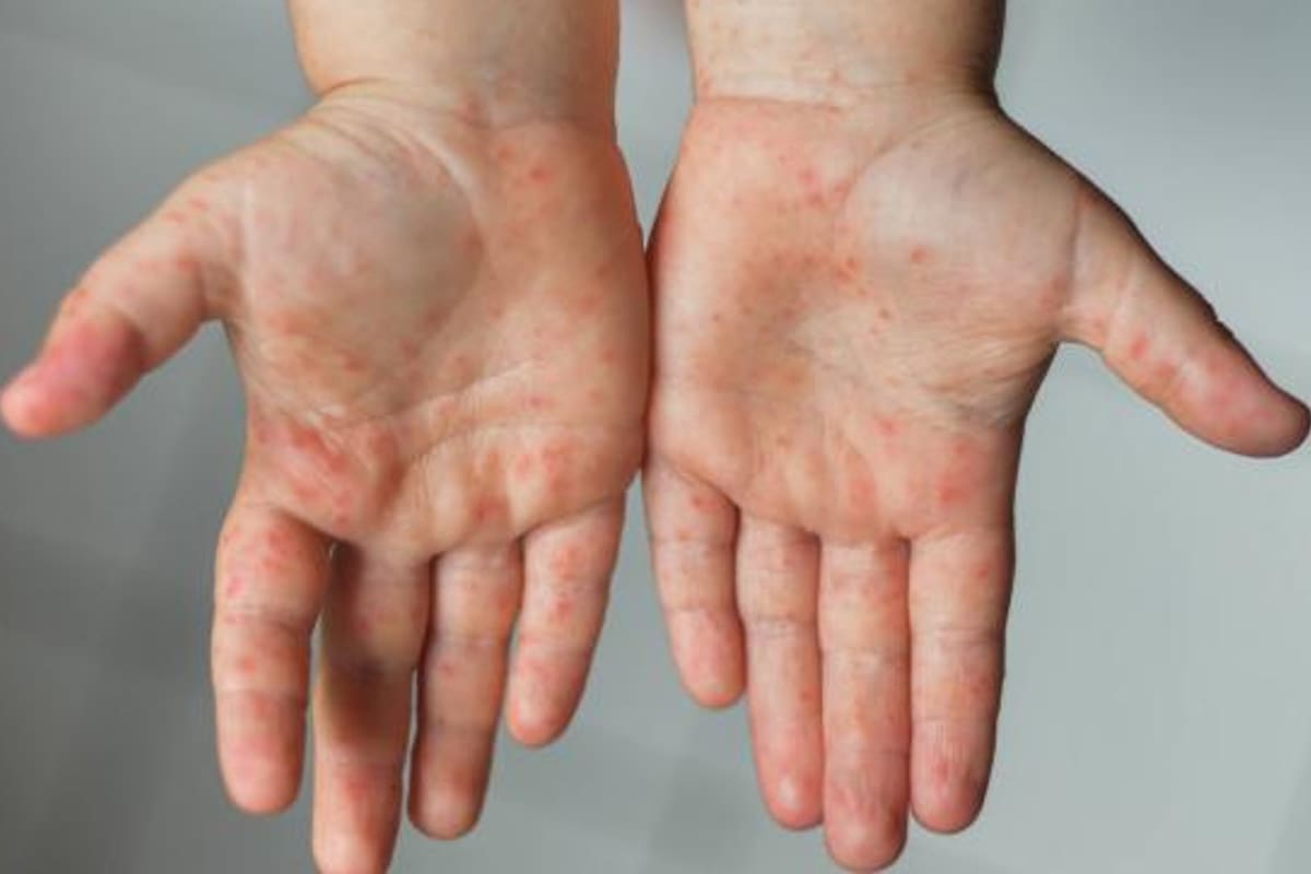 Los síntomas suelen ser la aparición de pústulas, fiebre, dolor corporal, cefalea o dolor de espalda, cansancio generalizado, e inflamación de ganglios, entre otros