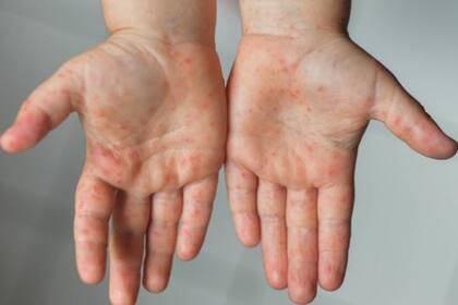 Los síntomas suelen ser la aparición de pústulas, fiebre, dolor corporal, cefalea o dolor de espalda, cansancio generalizado, e inflamación de ganglios, entre otros