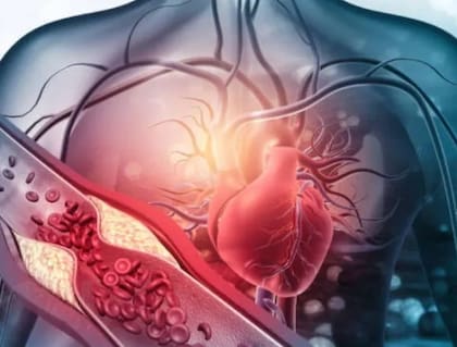 Los stents ayudan a mantener abiertas las arterias luego de una angioplastia y se colocan unos 105.000 por año en la Argentina