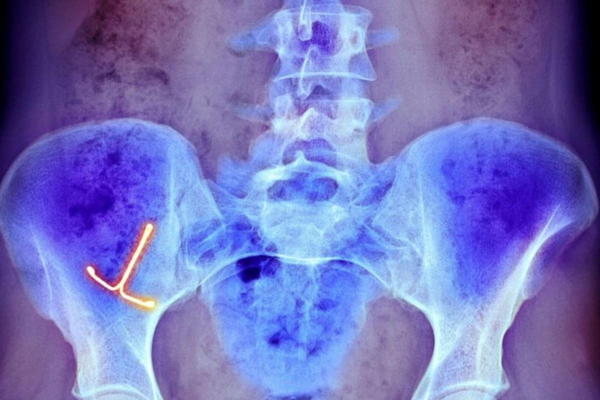 Los típicos objetos extraños vaginales incluyen dispositivos anticonceptivos intrauterinos dañados