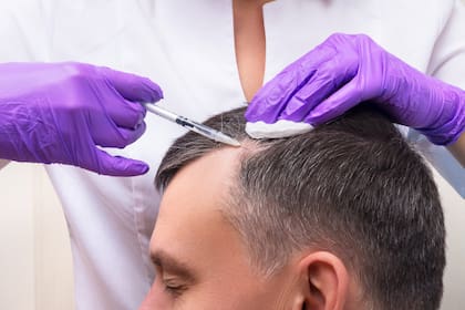 Los trasplantes capilares, shampoos que fortalecen el cabello y ciertas medicaciones fueron satisfaciendo el tan anhelado deseo de frenar la caída del pelo