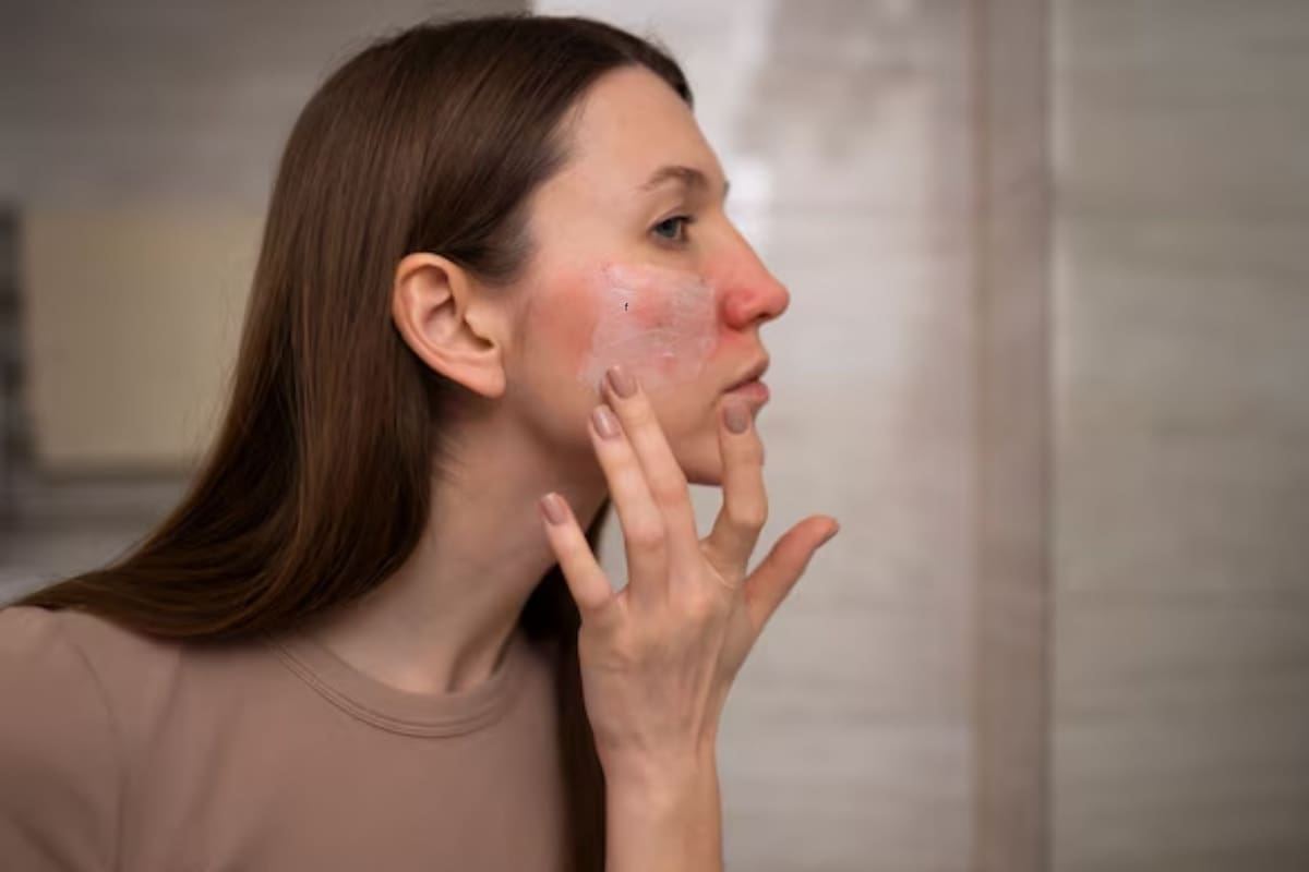 Los trucos para proteger tu piel en verano si tenés rosácea
