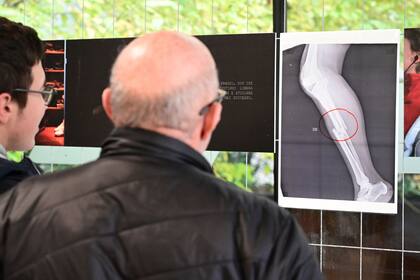 Los visitantes observan una radiografía de una tibia y peroné quebrados