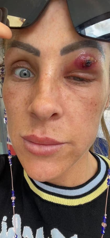 Louise Edwards se despertó con una extraña mancha en su ojo.