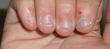 Luego de años de comerse las uñas, después de este susto, dejó de hacerlo.