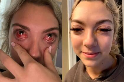 Luego de unas semanas y un tratamiento específico, la joven se recuperó ; FOTO: TikTok: @haley.fetzer_