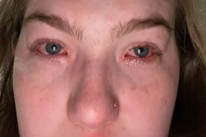 Luego de verse con su novio, la joven experimenta fuertes síntomas de alergía