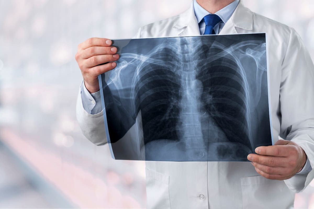 lung radiography concept. radiology doctor examining at chest x ray film of patient at hospital room.