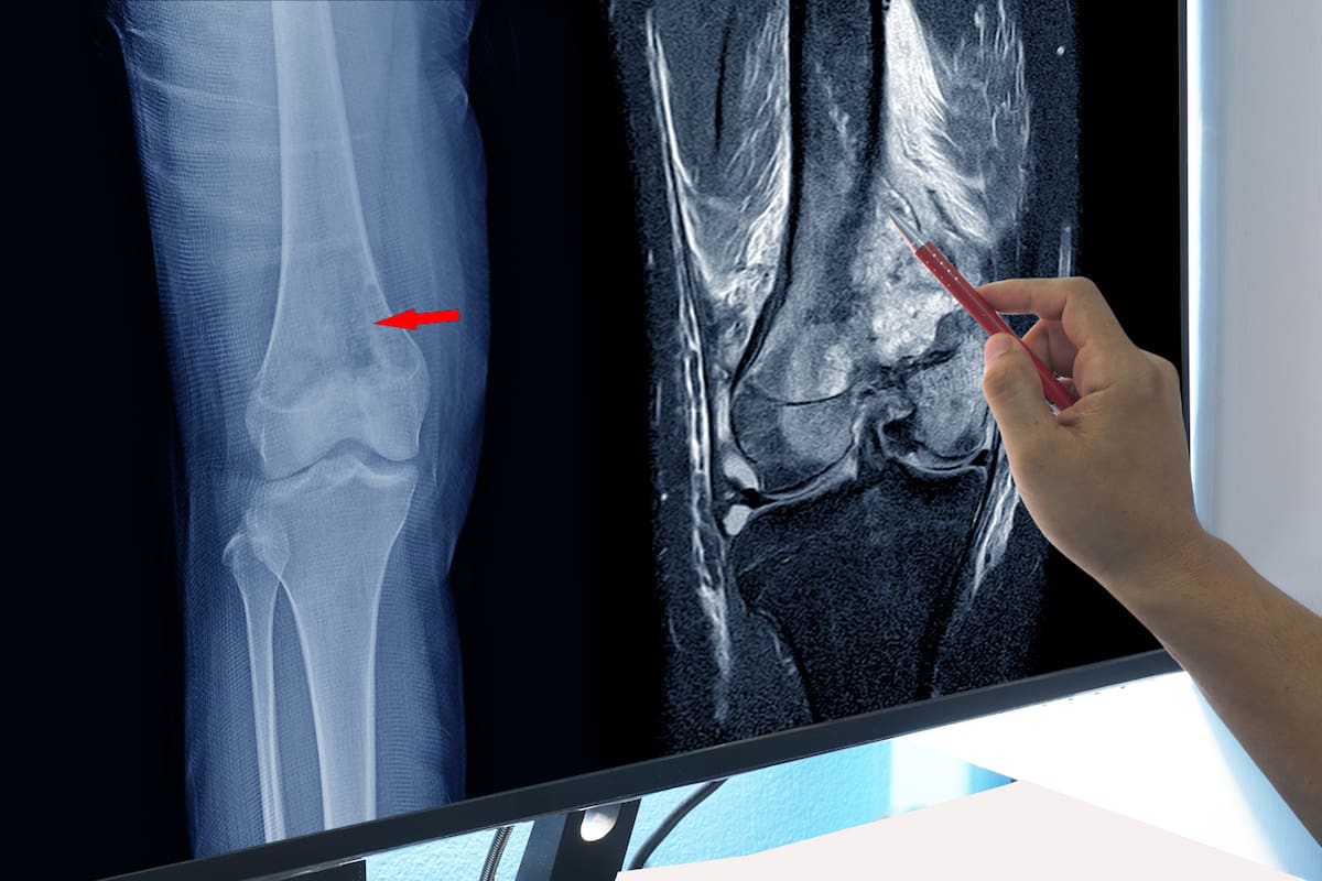 Magnetic Resonance Imaging (MRI) OF RIGHT KNEE Suggestive of malignant bone tumor, involving epiphysis and metadiaphyses of right distal femur,
on hand doctor point,Medical healthcare concept.