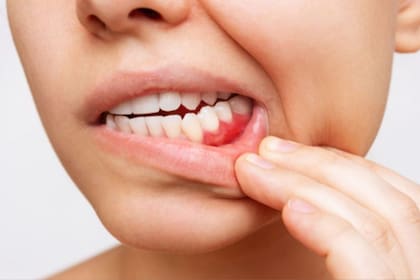 Mal aliento: la posible solución de frutas y hierbas para la halitosis