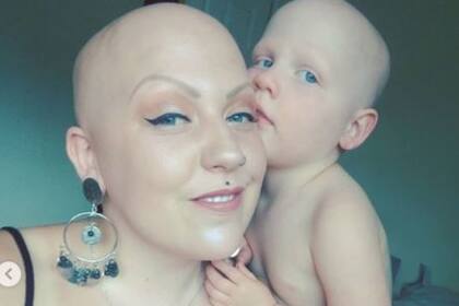 Mamá e hija son ejemplo de fortaleza para enfrentar la calvicie