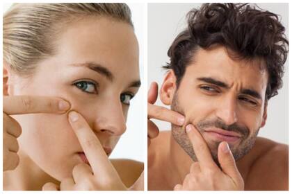 Manipular la piel con brotes de acné no es bueno por el riesgo de infección - Imagen: Google