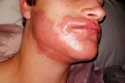 Marno Botha sintió una fuerte hinchazón en su cara por el contacto con la tintura