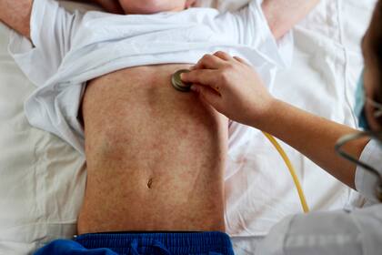 Más de 100 millones de chicos están en riesgo de contraer sarampión