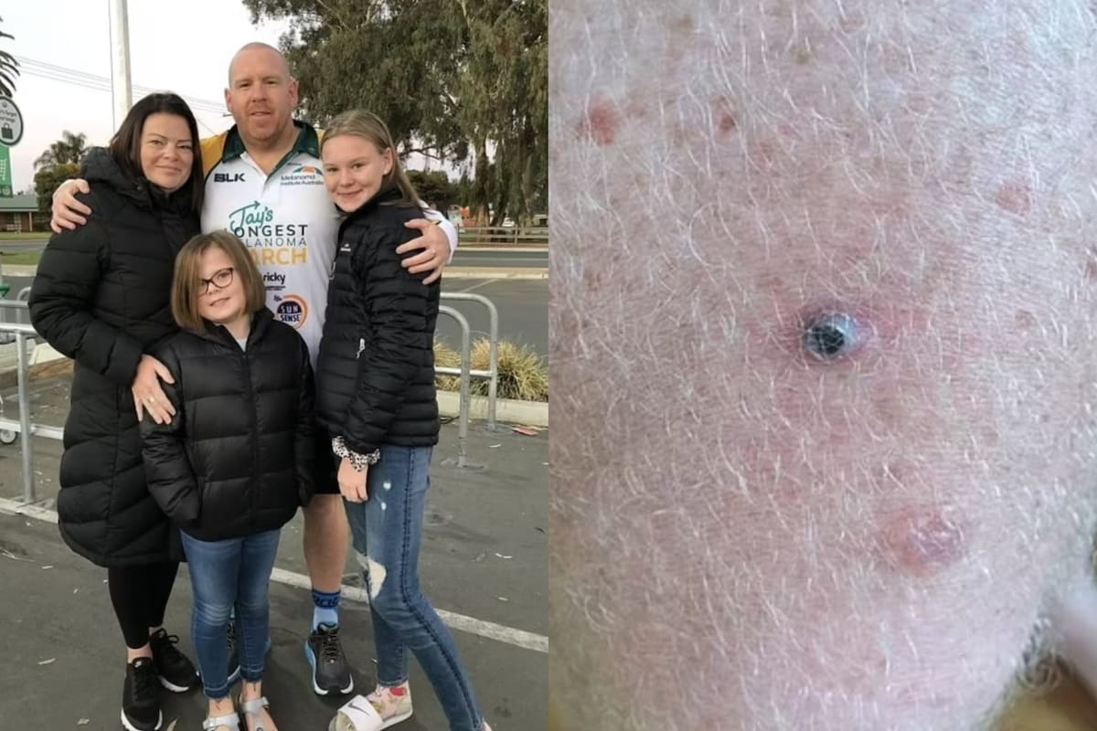 Matt Kean, de 47 años, notó una leve anomalía en su muslo mientras trabajaba en el jardín un fin de semana