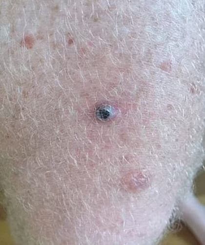 Matt pensó que lo había picado una araña, pero la verdad era otra