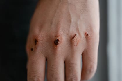 Melanina sintética: se trata de un tratamiento innovador para recuperar la piel (Foto Pexels)
