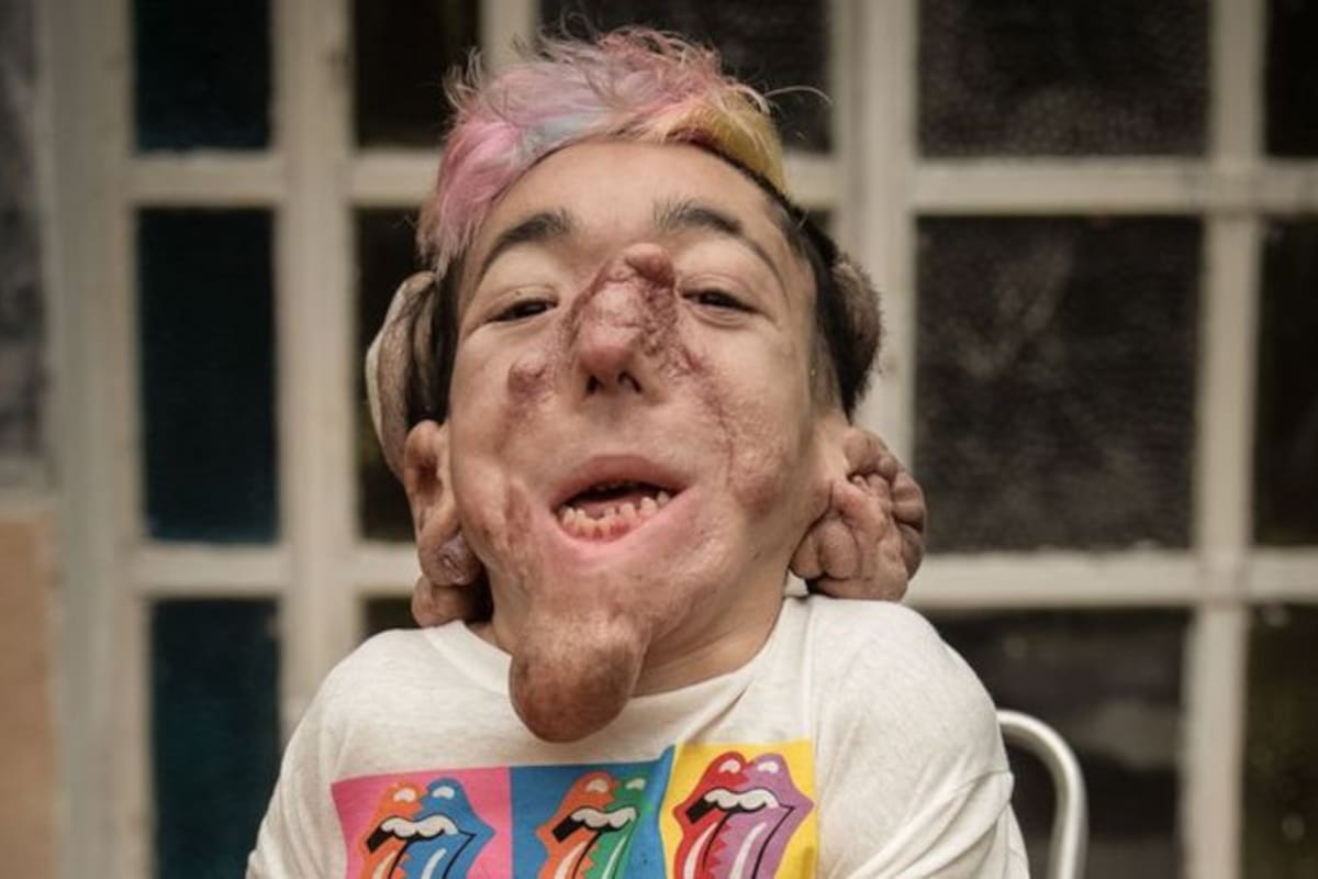 “Mi cuerpo parece el de un humano que estaba a punto de transformarse en monstruo pero se trabó, se quedó en la mitad del proceso. Mitad vida, mitad muerte”, escribió Matías Fernández Burzaco sobre sí mismo