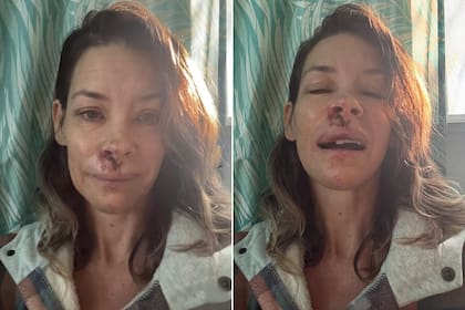 Moretones, sangre y un diente roto: Evangeline Lilly contó detalles del accidente que sufrió, junto a una profunda reflexión