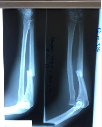 Morgan Segui sufrió múltiples fracturas tras su accidente en Timor Oriental, como esta del brazo derecho, expuesta en una radiografía