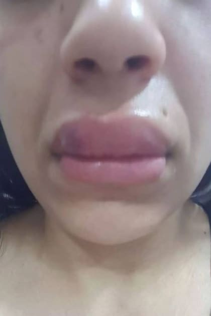 Nadia desconoce qué producto le colocaron en sus labios, pero sospecha que no se trató de ácido hialurónico