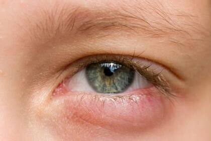 Nadie pudo entender la letra del doctor y, por error, le dieron una crema peligrosísima para el ojo que casi la hace perder la vista.