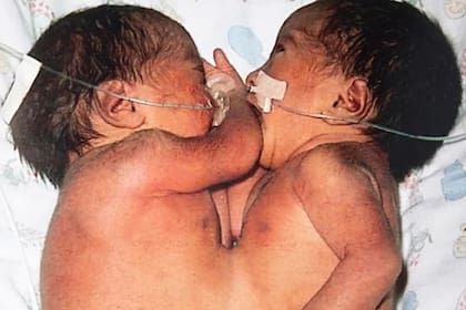 Nadie tenía fe en que pudieran sobrevivir separadas pero los padres se arriesgaron y las chicas hoy lucen maravillosas.