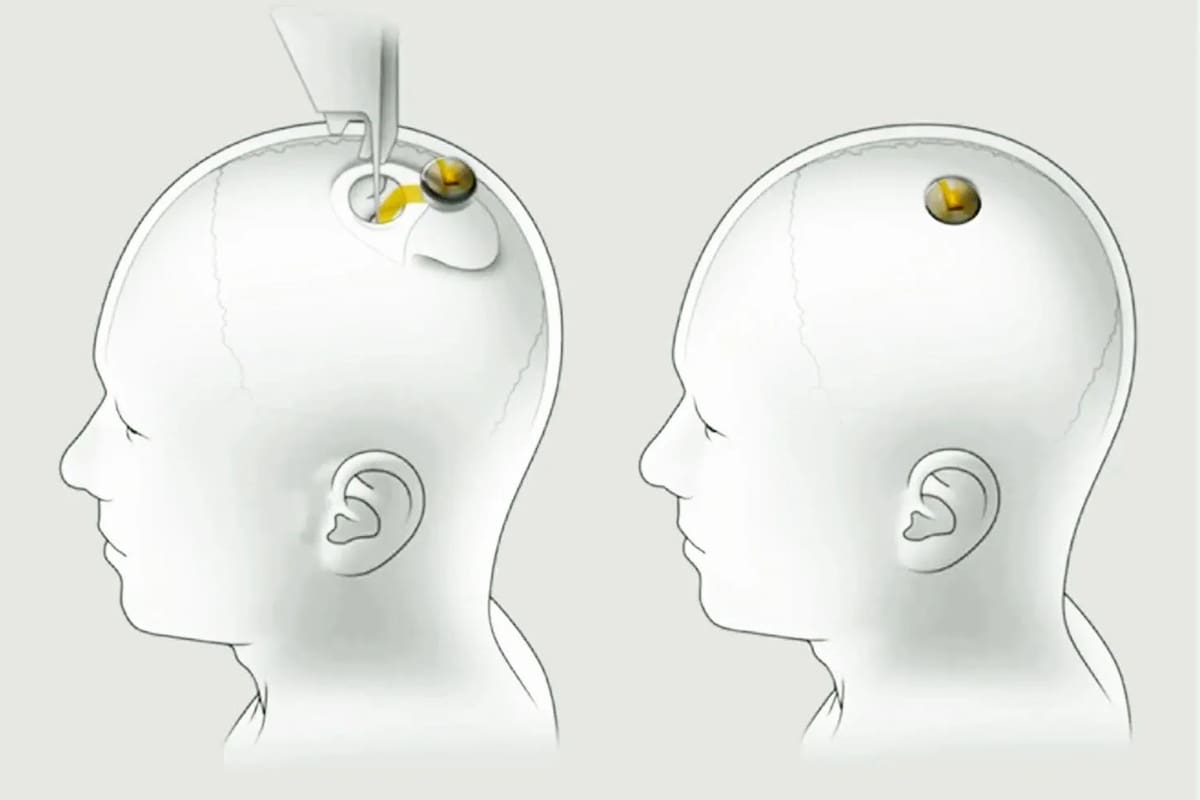 Neuralink es un chip que se instala en el cráneo, y que inserta unos tentáculos ultradelgados, capaces de leer y emitir señales eléctricas para interactuar con el cerebro y el sistema nervioso; también tiene una bateria y una antena Bluetooth