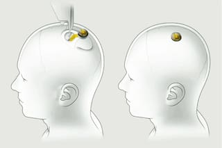 Cómo funciona Telepathy, el chip que permite hablarle a una computadora con el pensamiento