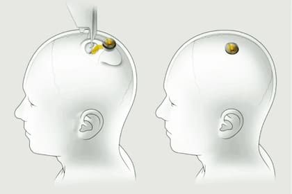 Neuralink, la empresa de Elon Musk, espera luz verde para instalar chips capaces de leer y emitir señales eléctricas para interactuar con el cerebro y el sistema nervioso