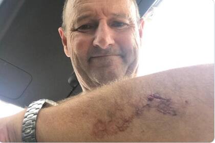 Nick Minogue mostrando su herida tras el ataque de un tiburón blanco.